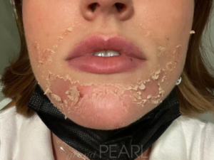 young woman at medical spa who had a chemical peel